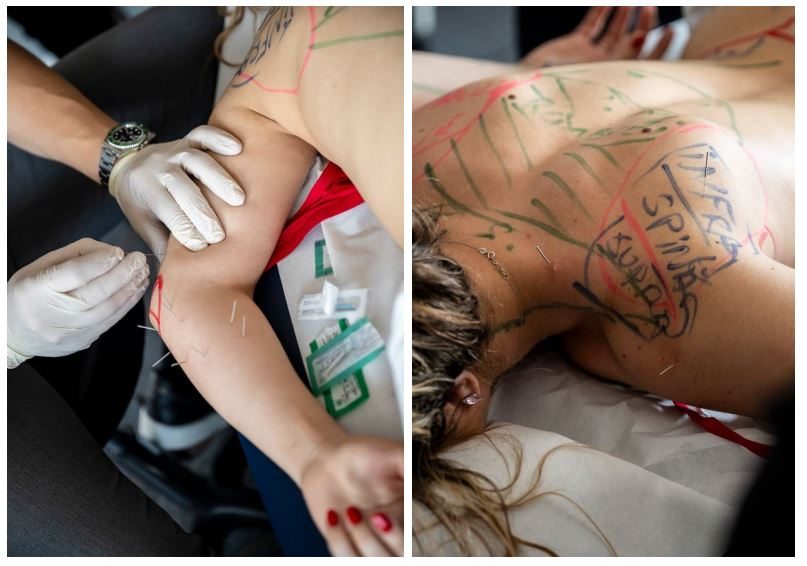 curs dry needling medboost academy – aplica acupunctura musculara in tratamentul durerii miofasciale
